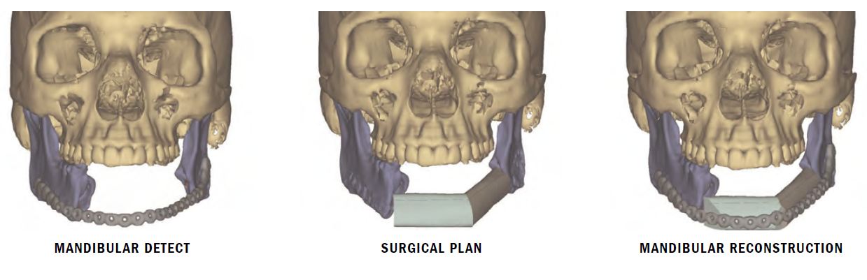 下颌骨重建图