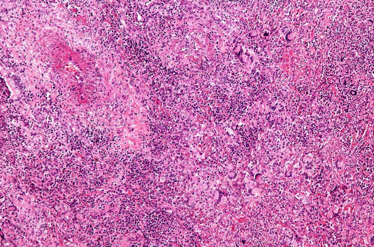 肉芽肿病的影像与Polyangiitis:病人受益于多学科治疗