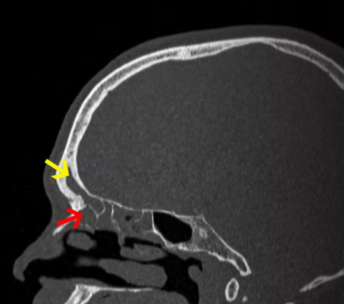 该矢状窦CT显示了未打开的额窦（由黄色箭头指示）。在手术时，额窦充满了保留的分泌物和肿胀的组织。在手术过程中，除去额窦凹陷（由红色箭头指示）的组织阻塞的组织。在解剖过程中，请注意在额叶凹陷的外壁保持组织，以便窦可以恢复正常功能。