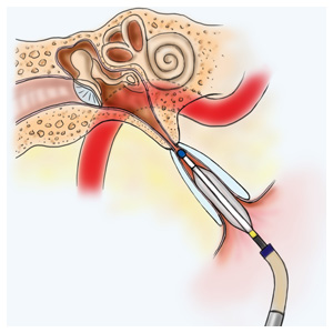 图像从气球咽鼓Tuboplasty慢性咽鼓管功能障碍