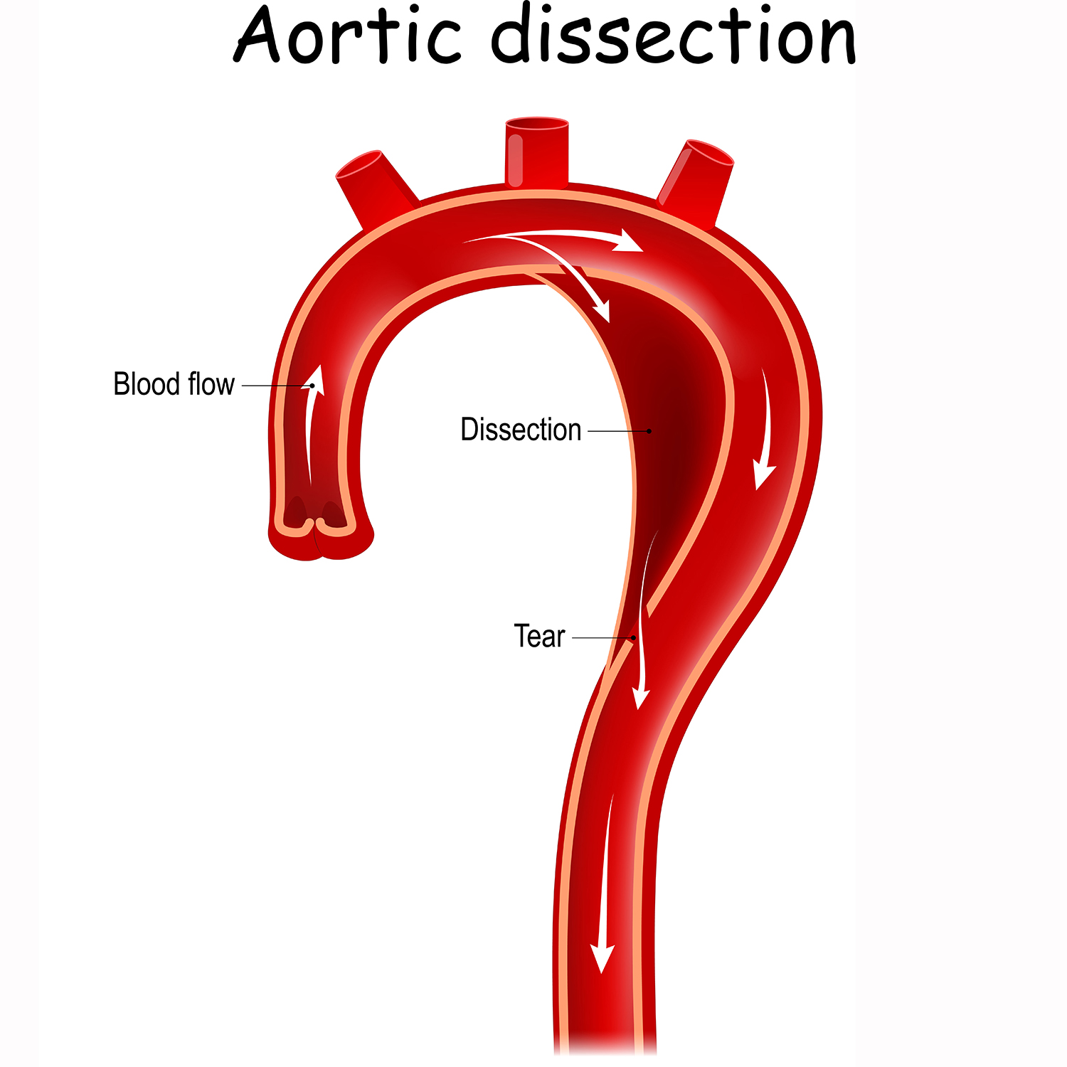 Aortic Dissection - Biobank Facilities